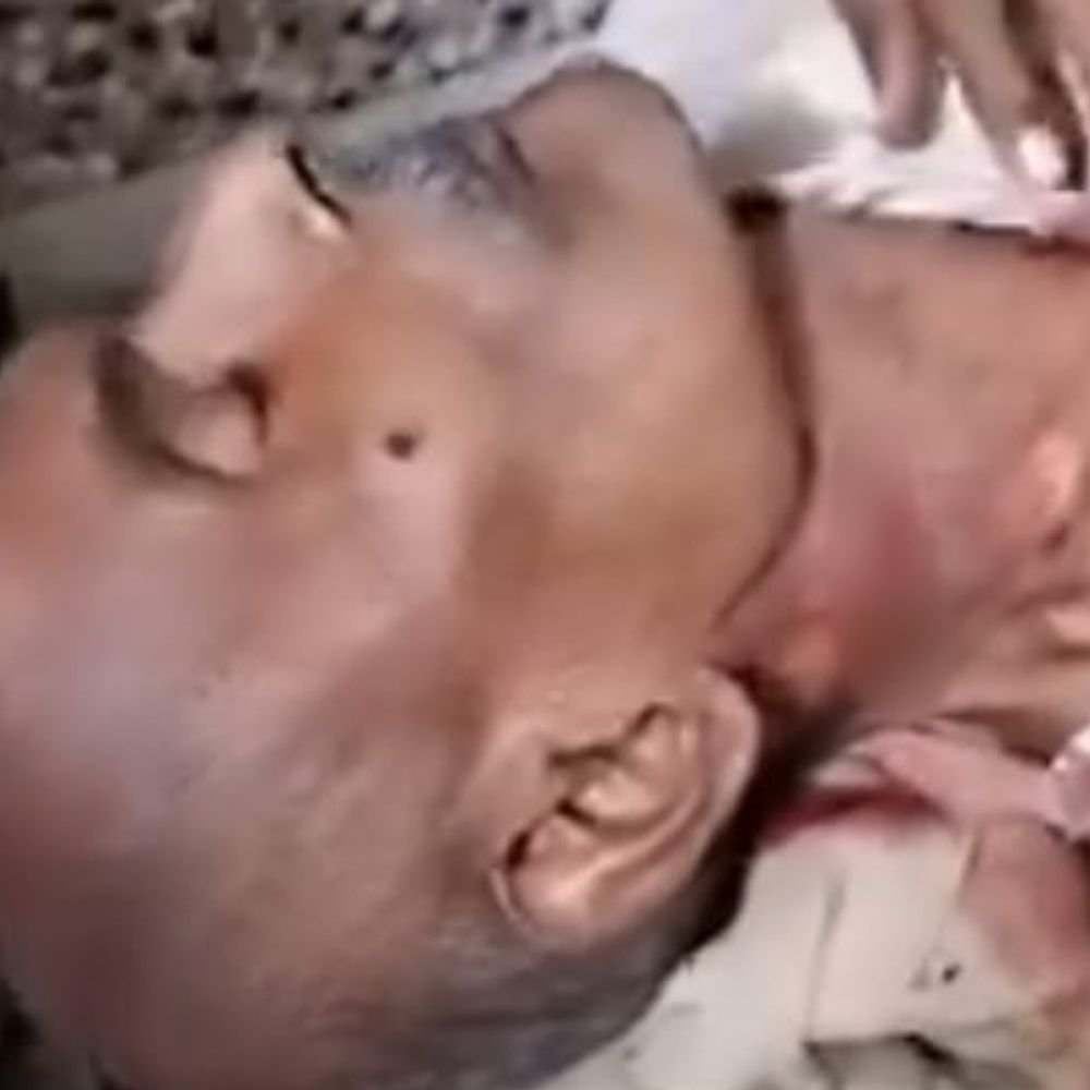 मथुरा में बंदरों के हमले से ग्रामीण गंभीर घायल:गर्दन की नस कटी, ज्यादा खून बहने से हालत बिगड़ी; अस्पताल में भर्ती
