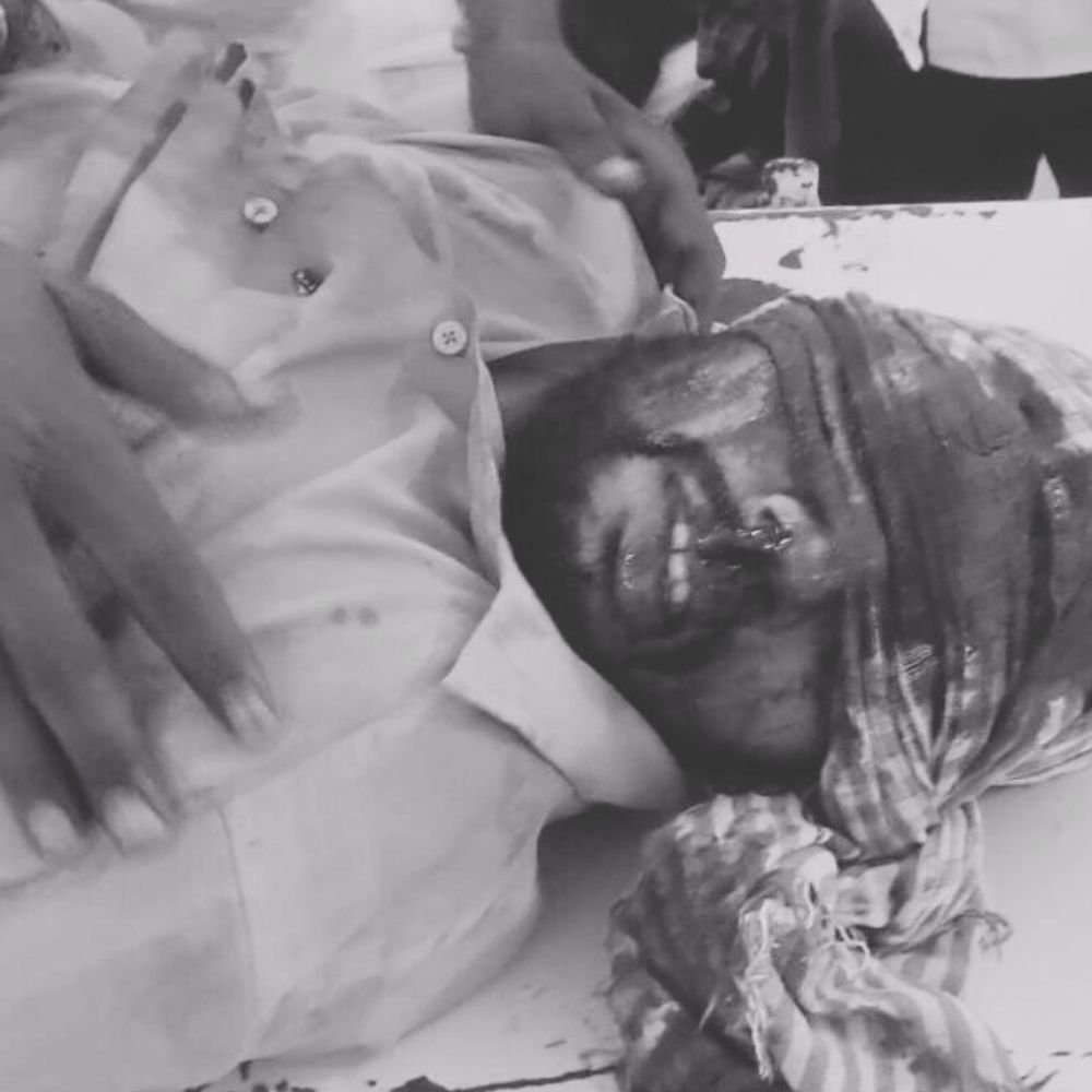 हाईटेंशन लाइन की चपेट में आकर युवक गंभीर झुलसा:छत पर काम करते समय हादसा, धमाके की आवाज सुनकर पहुंचे परिजन