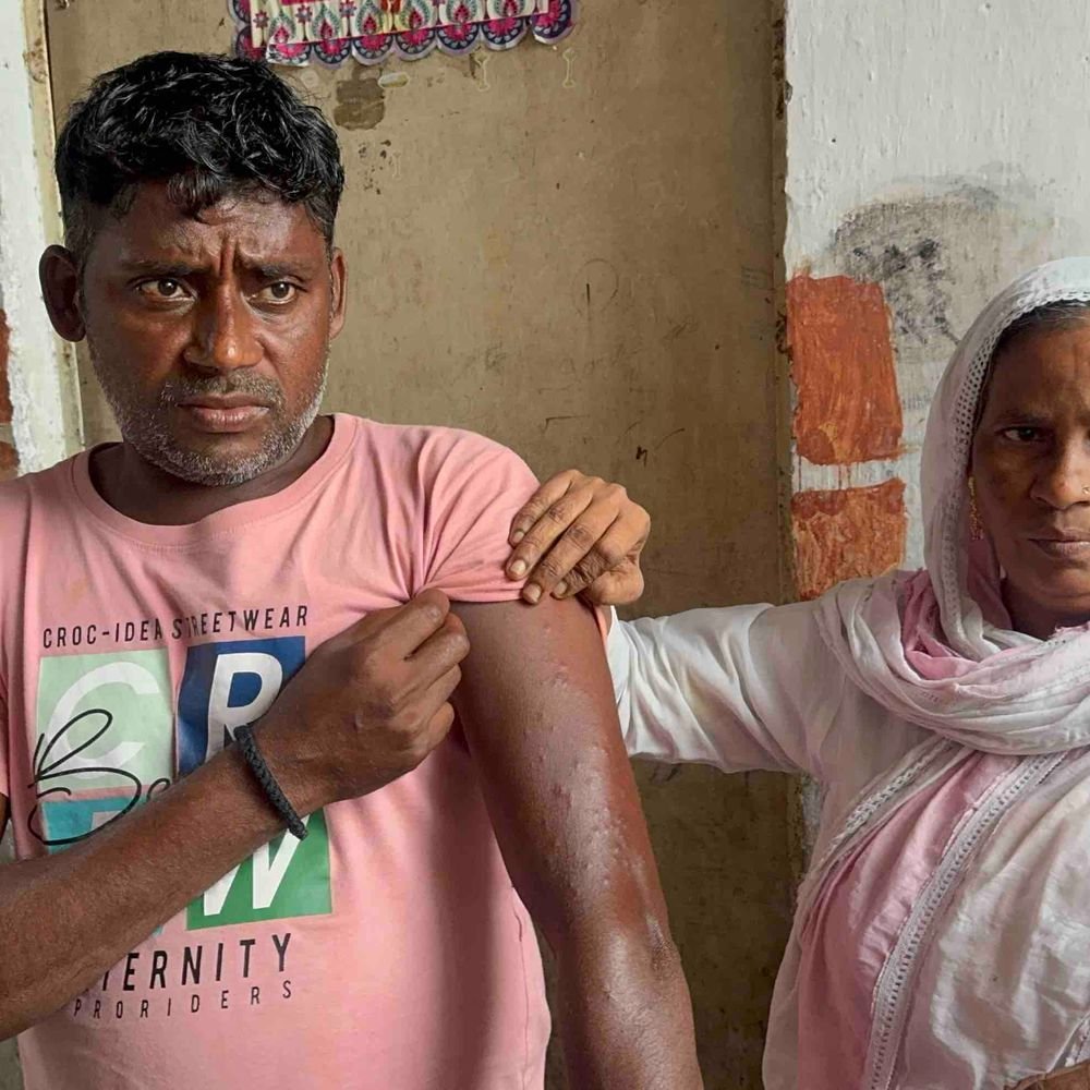 बच्चों के विवाद में युवक के सीने पर तमंचा ताना:फायर करने पर हाथ में धंसे 40 से ज्यादा छर्रे, आरोपी फरार
