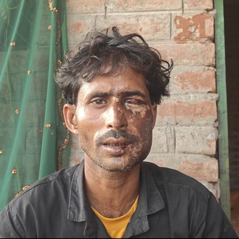 मोहनलालगंज में ज्वलनशील पदार्थ डालकर किसान से बाइक लूटी:चेहरा व एक आंख भी झुलसी, बाइक देने से मना करने से नाराज था