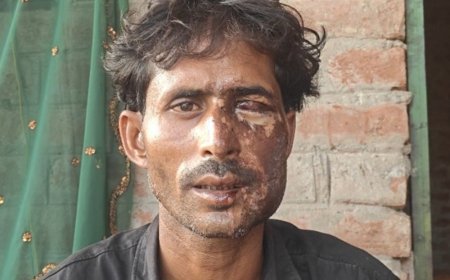 मोहनलालगंज में ज्वलनशील पदार्थ डालकर किसान से बाइक लूटी:चेहरा व एक आंख भी झुलसी, बाइक देने से मना करने से नाराज था