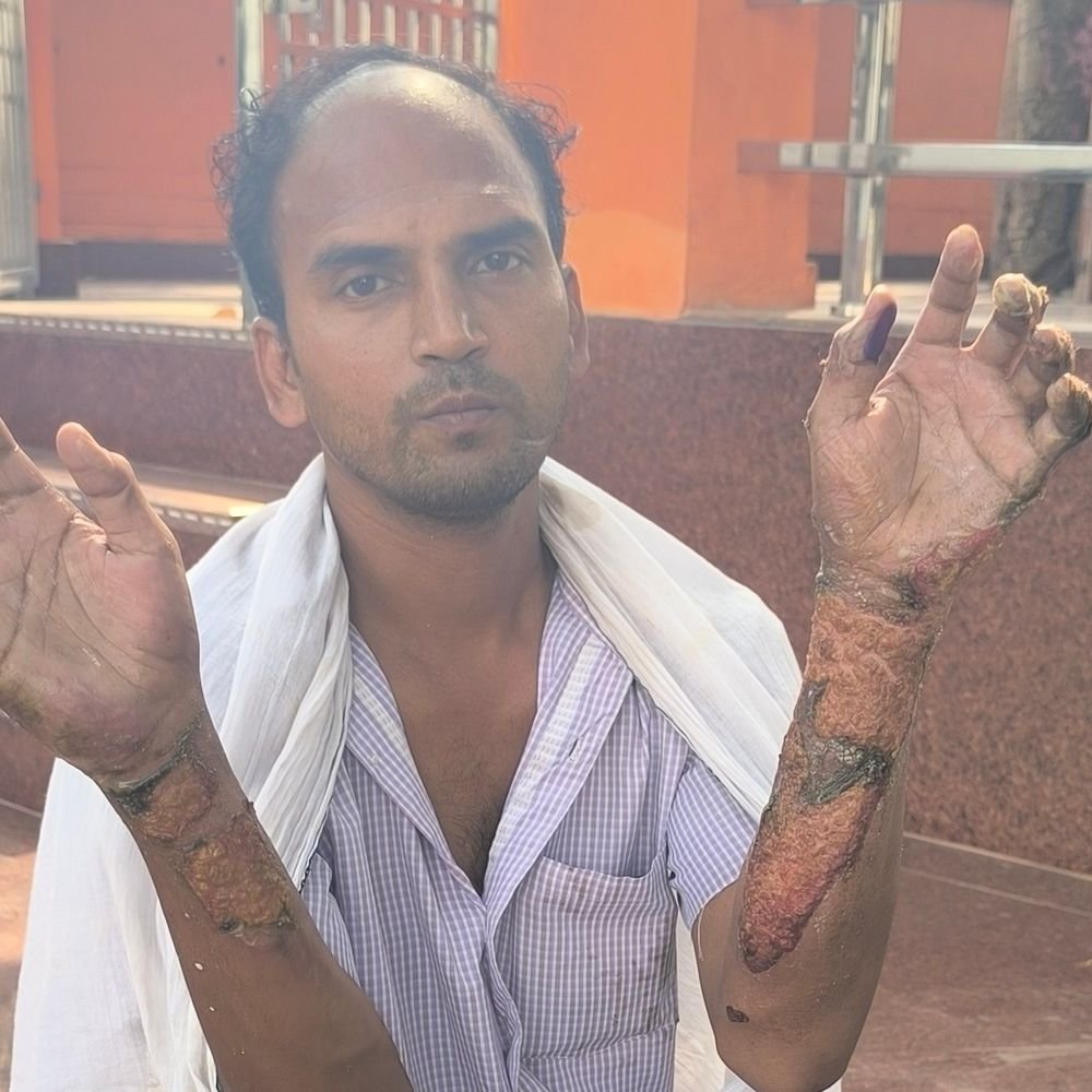 मैनपुरी में युवक पर तारपीन डालकर आग लगाई, झुलसा:गंभीर हालत में अस्पताल में भर्ती कराया, पुलिस ने केस दर्ज कर जांच शुरू की