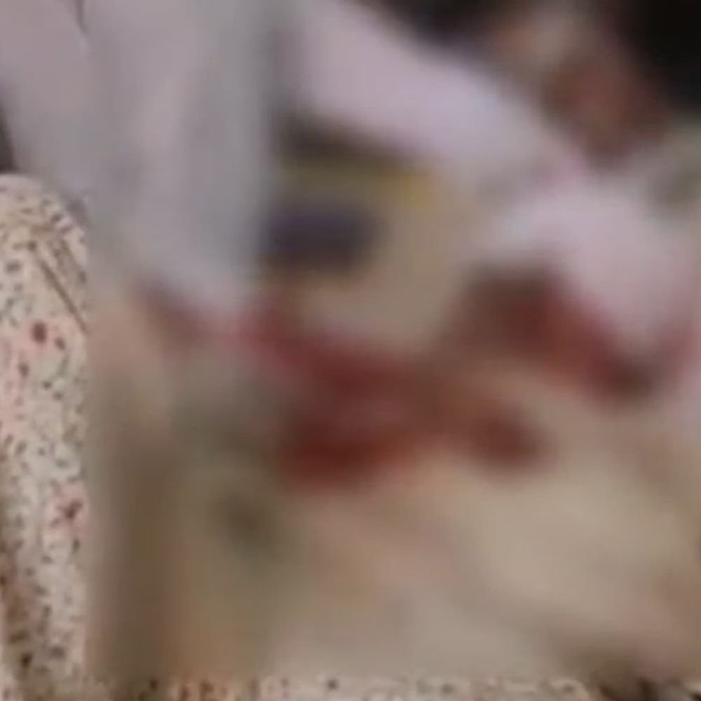 हाथरस में बाल कल्याण समिति अध्यक्ष घायल:कार अनियंत्रित होकर गड्ढे में गिरी, मथुरा से हाथरस आते समय हादसा