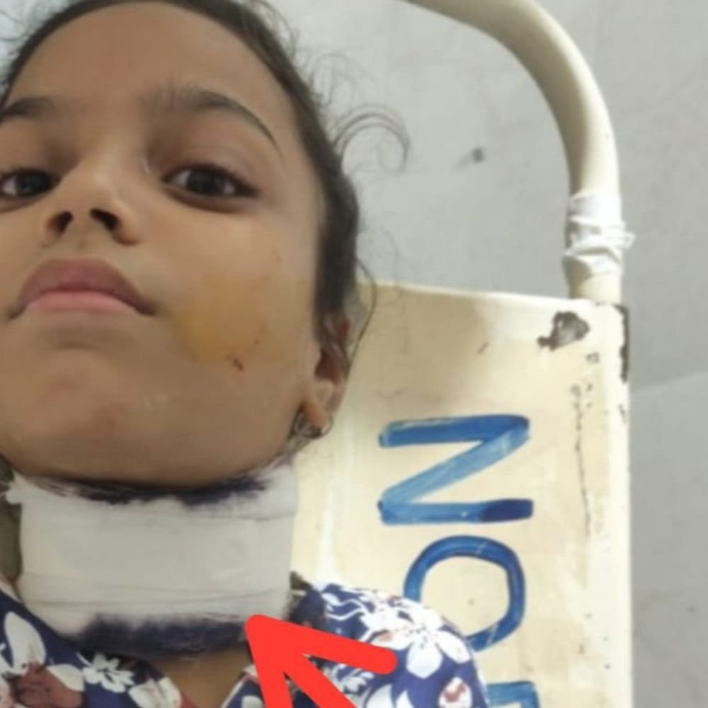 मांझे से 9 साल की बच्ची का गला रेता:ट्रॉमा सेंटर में ऑपरेशन कर बचाई जान, पिता के साथ बाइक से घर लौट रही थी