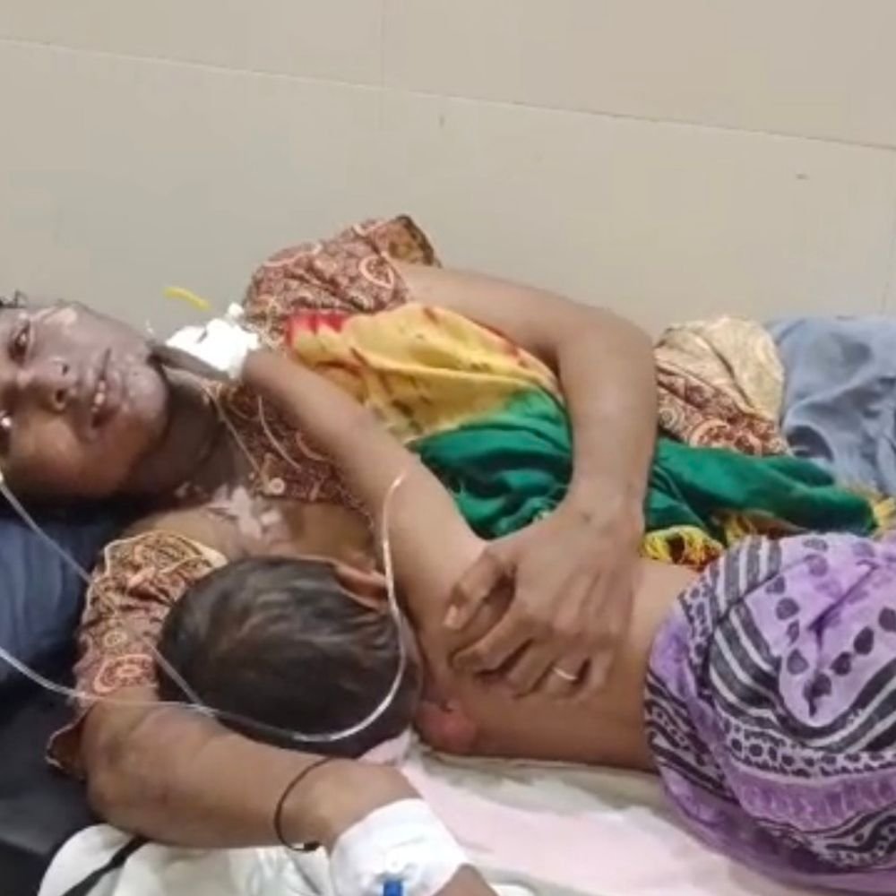महराजगंज में झगड़े में खौलता तेल फेंका, मां-बेटी झुलसीं:कोटवा पिपरिया गांव में देवरानी-जेठानी के बीच विवाद; जिला अस्पताल में भर्ती