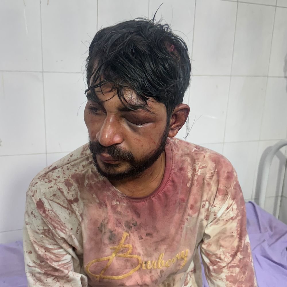 बुलंदशहर में युवक का अपहरण कर आंख फोड़ी:जमीनी विवाद में सिर और पैर कुचले, जंगल में फेंका; गंभीर हालत में भर्ती