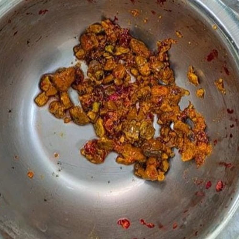 पित्त की नली से निकले 70 पत्थर:29 साल से पथरी से परेशान था युवक, मेडिकल कालेज में हुआ आपरेशन