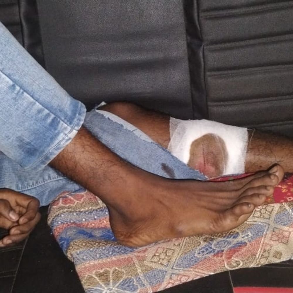 दौड़ के बहाने बुलाकर किशोर को गोली मारी:पैर में लगी बुलेट, कक्षा 10 का छात्र आरोपी; दोनों नाबालिग