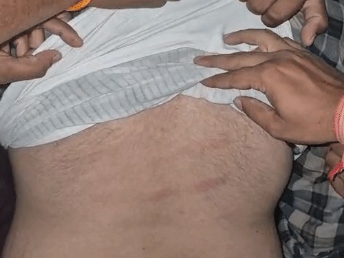 अलीगढ़ में आरएसएस के विद्यार्थी प्रमुख को बेल्टों से पीटा:शराब ठेके के पास सड़क पर यातायात बाधित कर रहा था टेंपो, विरोध पर साथियों को बुलाकर हमला