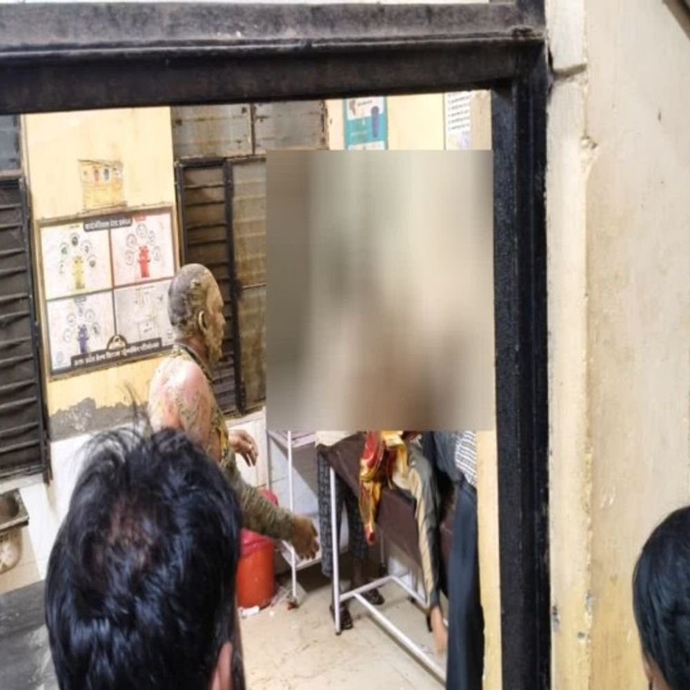 प्रेम-प्रसंग के विवाद में किशोरी और युवक ने आग लगाई:सुल्तानपुर में दोनों झुलसे; सीएचसी से राजकीय मेडिकल कॉलेज रेफर