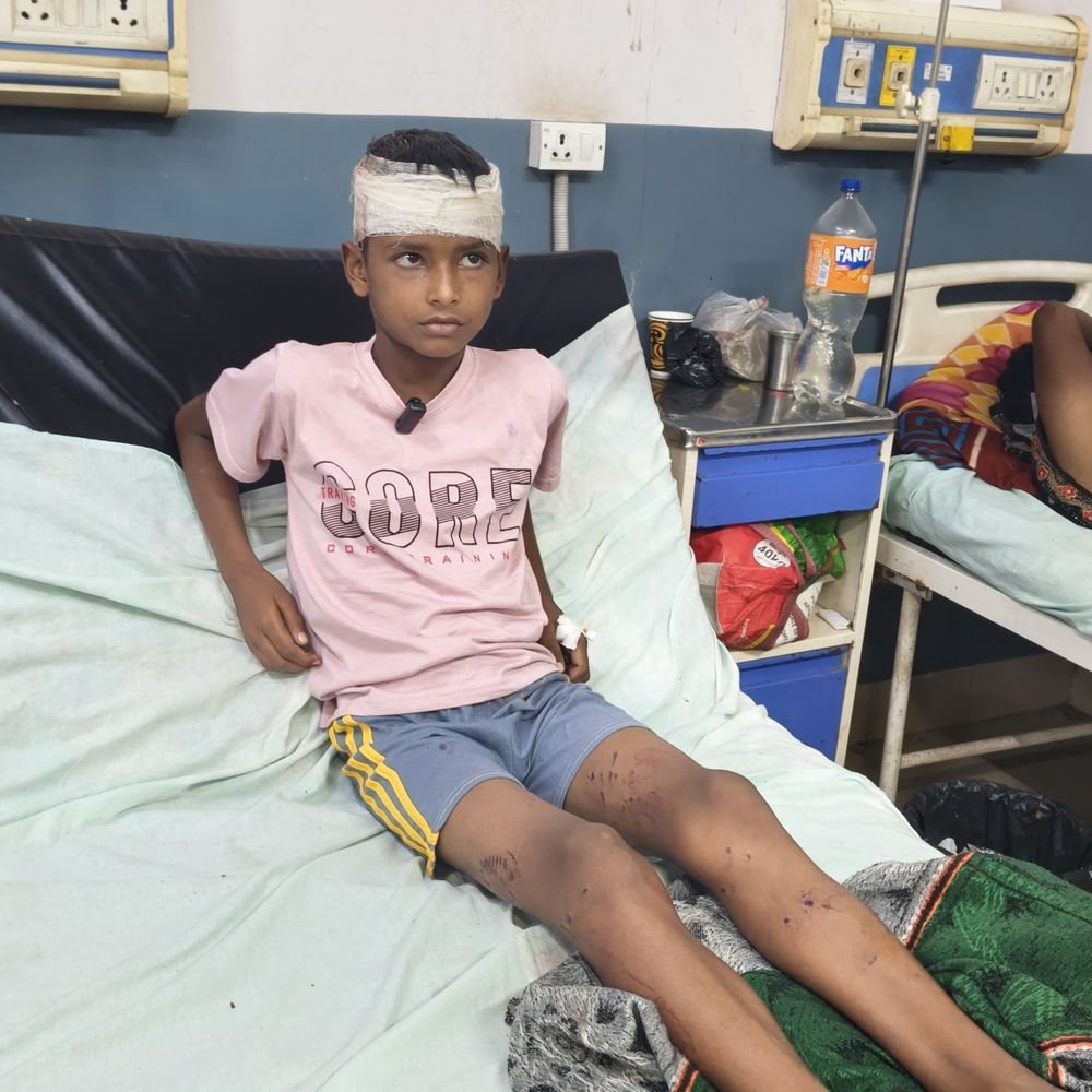 संभल में आवारा कुत्तों का आतंक, तीन बच्चों पर हमला:एक के सिर से मांस नोचा, 9 टांके लगे, तीन घायल