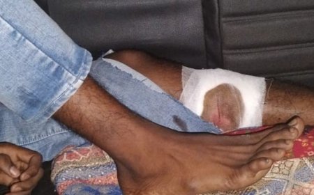 दौड़ के बहाने बुलाकर किशोर को गोली मारी:पैर में लगी बुलेट, कक्षा 10 का छात्र आरोपी; दोनों नाबालिग